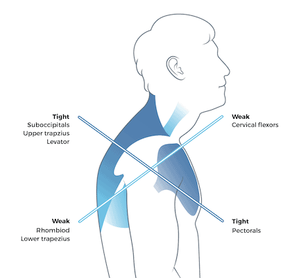 A diagram showing the muscles in the neck, shoulders, chest, and upper body that are affected, which you can use yoga for Upper Cross Syndrome to correct